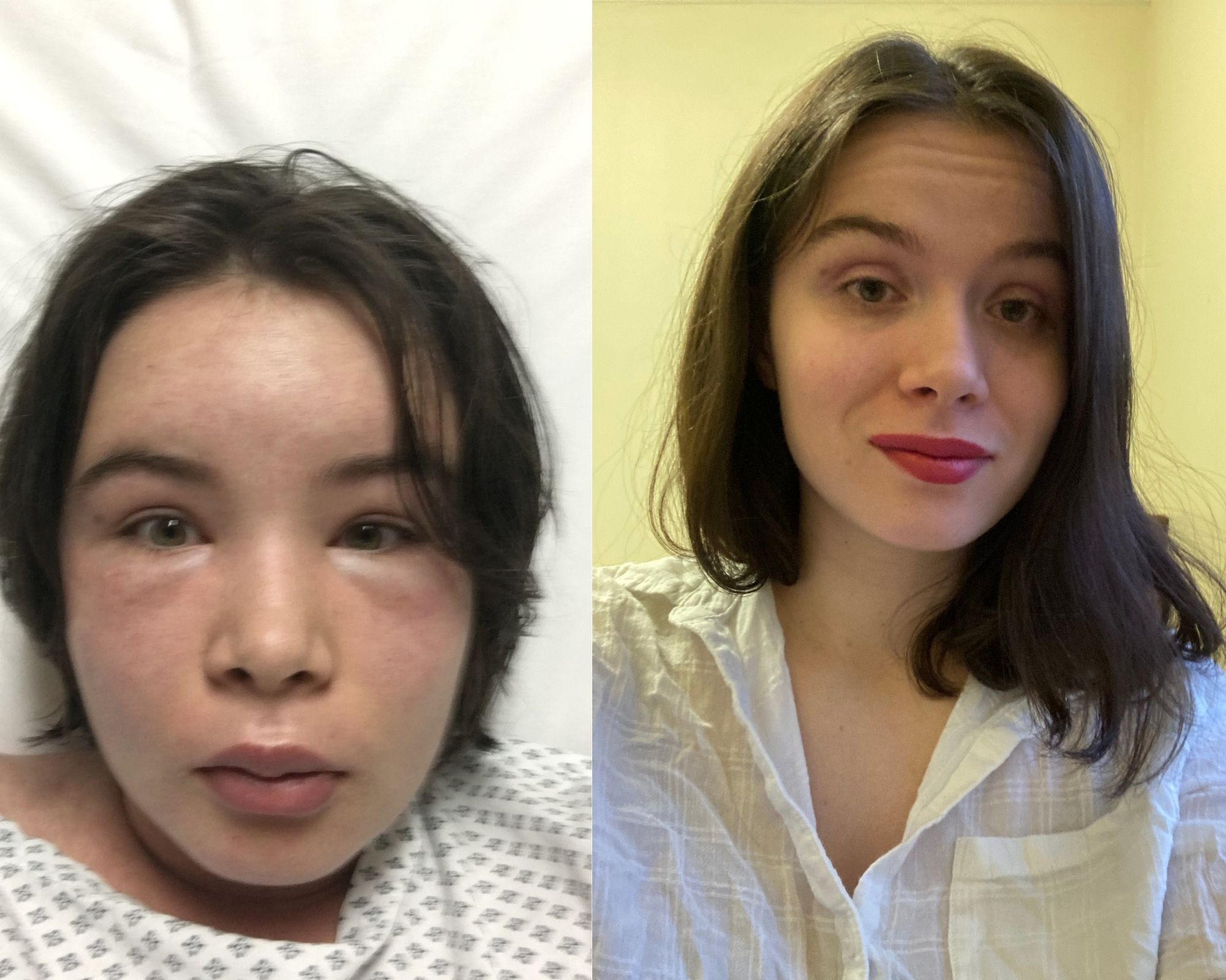 On the left, photo of brown-ahired white woman with severe inflammation on her face lying on a hospital bed, and on the right is a photo of the same woman without inflammation wearing makeup 